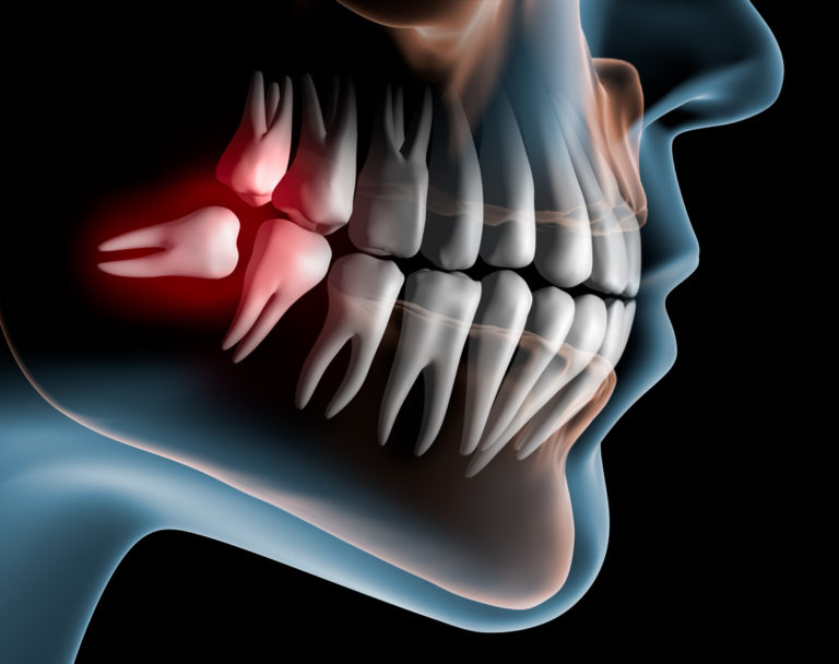 what-happens-if-i-don-t-remove-my-wisdom-teeth-shodhan-dentistry