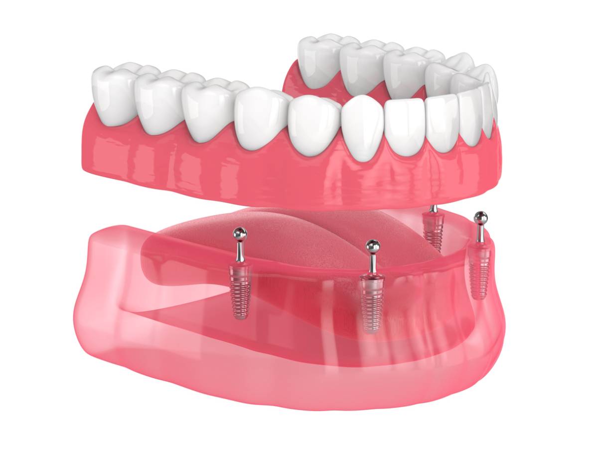 concept image of implant-supported dentures on gums