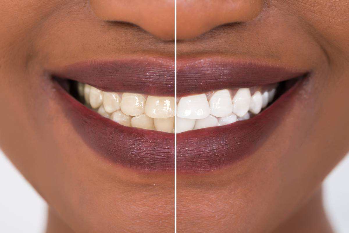 Concept image for teeth whitening before and after