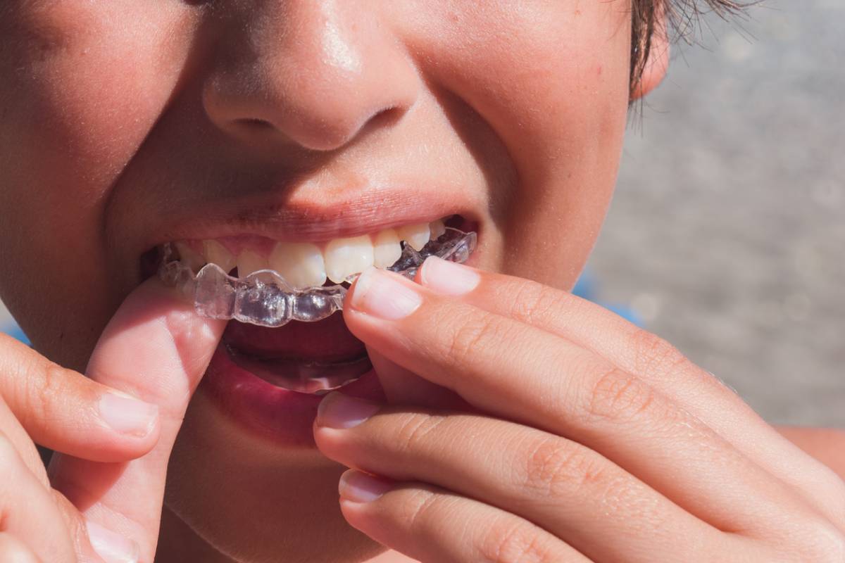 concept of tips to optimize invisalign treatment