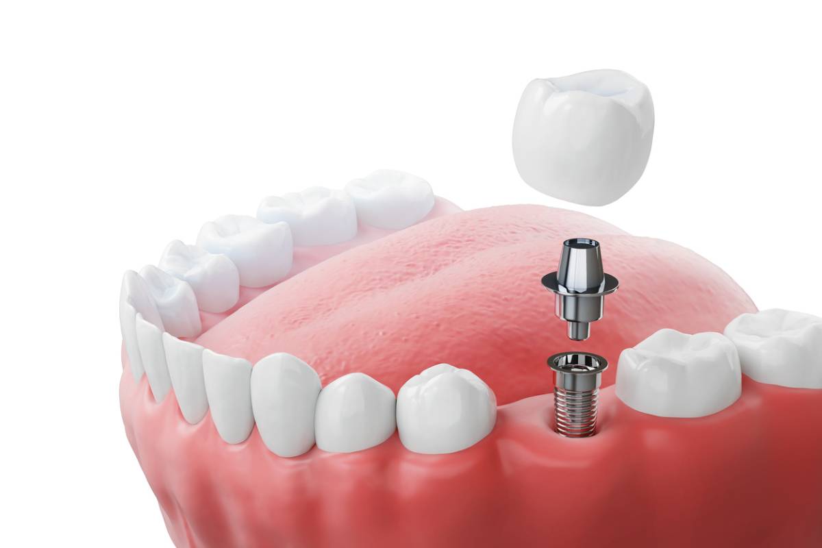featured image for preparing for dental implant placement