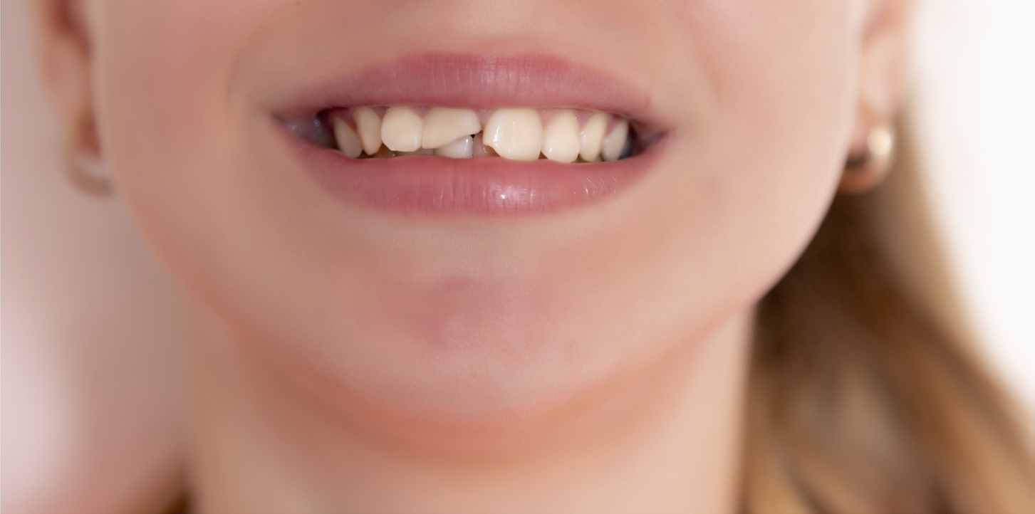 The image is a close up of a kid's broken teeth to represent if children can get dental implants.