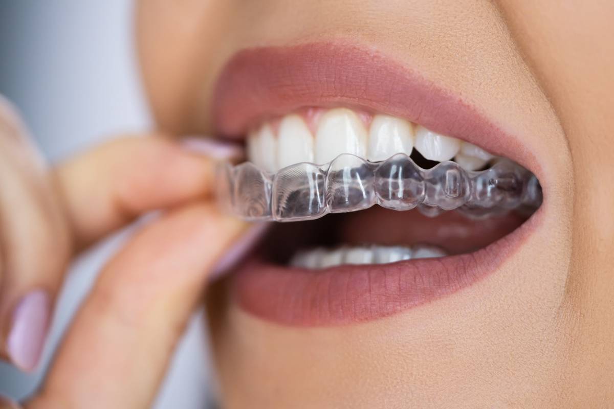 Featured image for Can Invisalign Fix Overbite