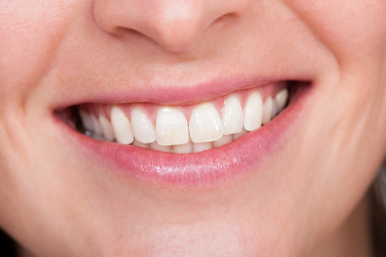 Close-up Of A Young Woman With Dental Smile